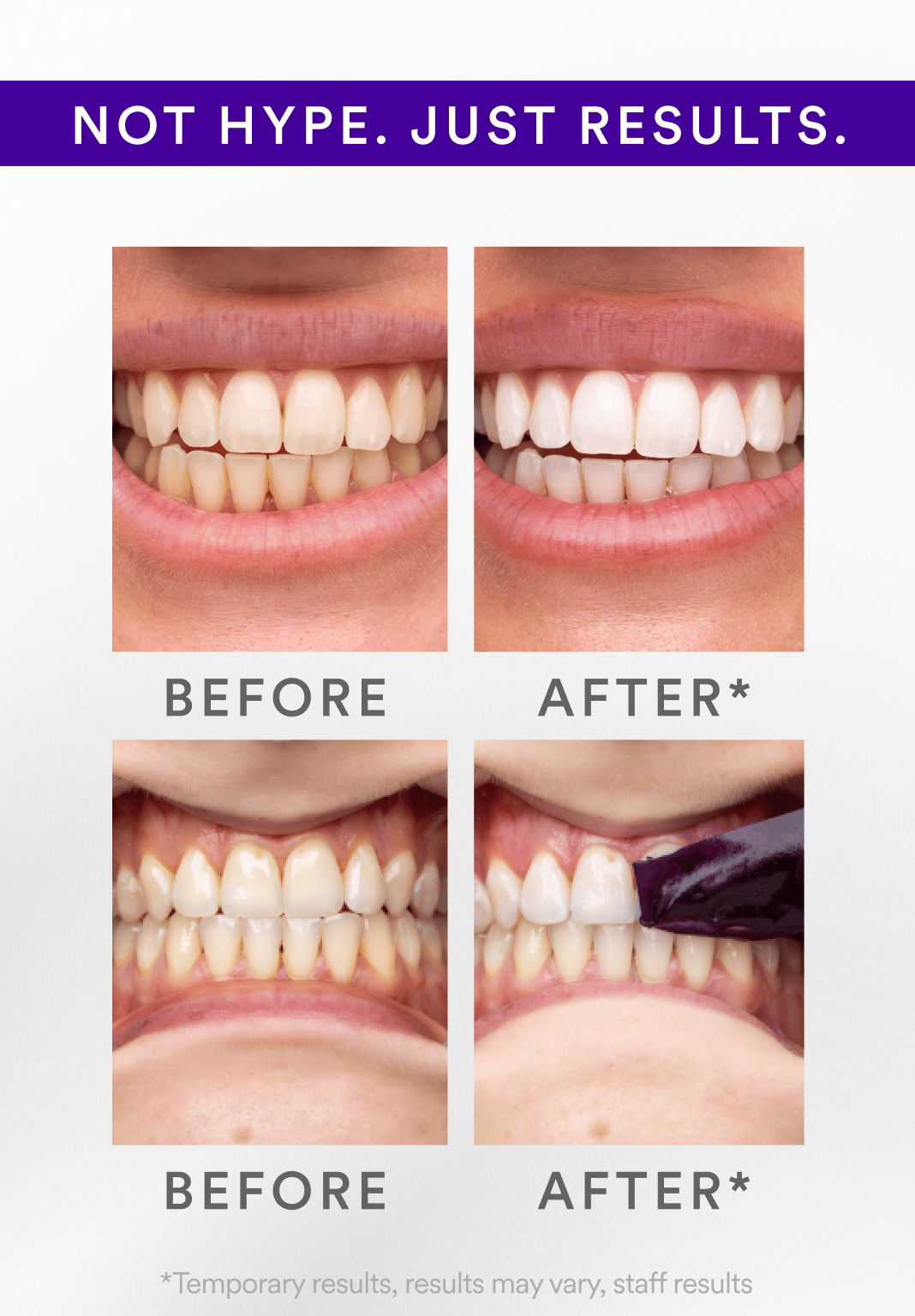 TLOPA® Official Store💎Whitening Strips