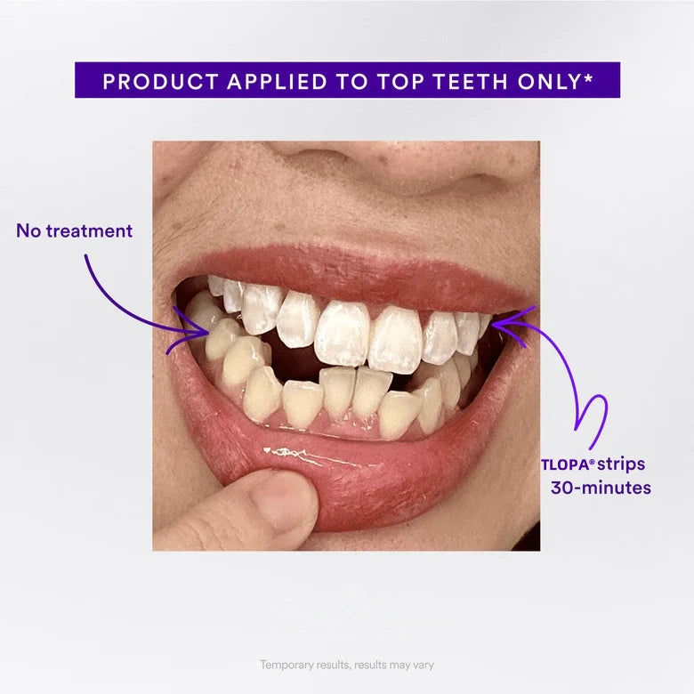 TLOPA® Official Store💎Whitening Strips